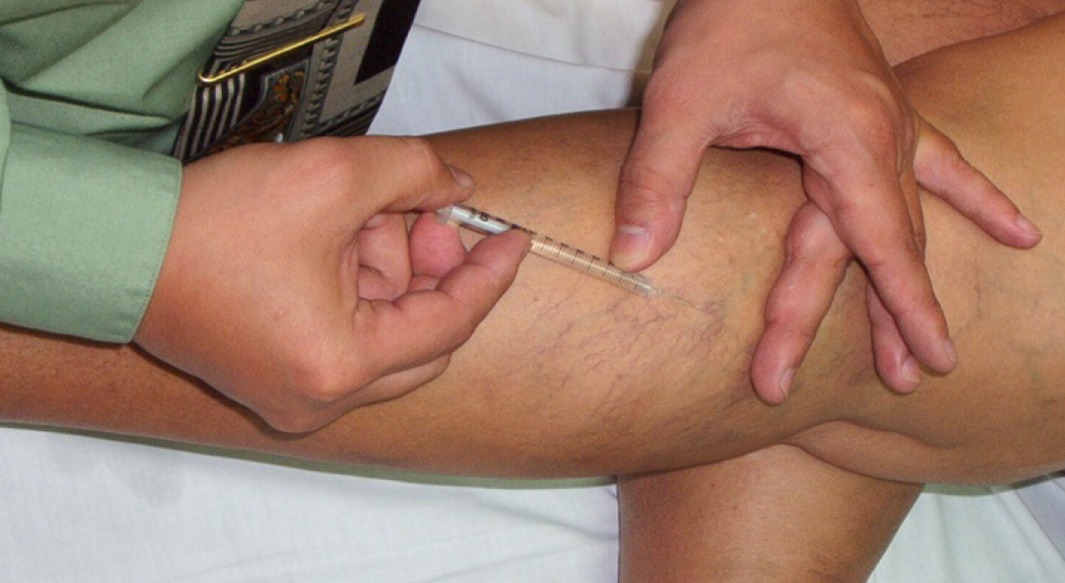 Procedimiento sobre una rodilla