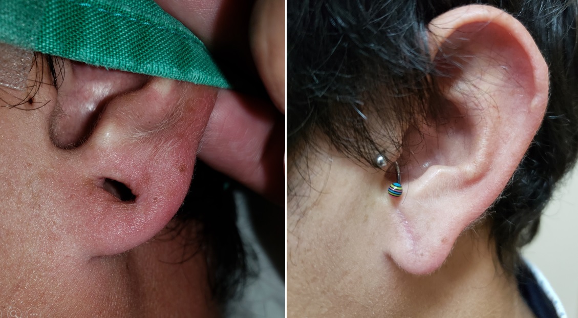 Dos fotografías de una oreja