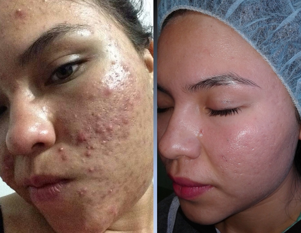 Dos fotografías de la piel del rostro