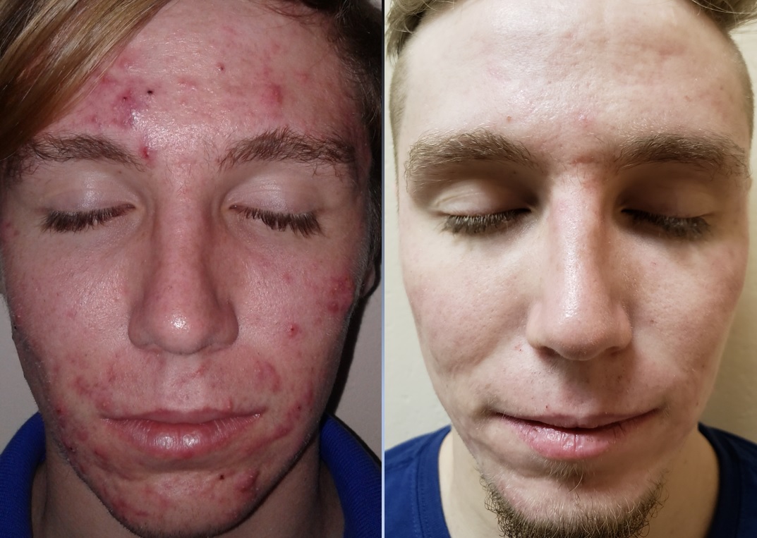 Dos fotografías de la piel del rostro